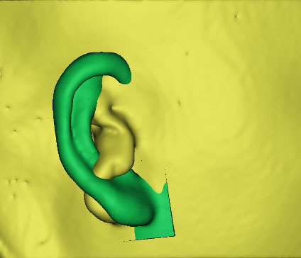 小耳畸形怎么辦？這有一份三維數(shù)字化治療方案請(qǐng)簽收！
